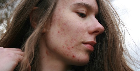 acne