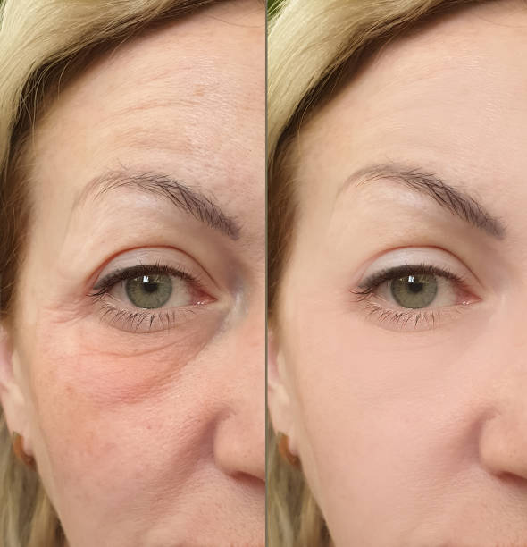 woman face wrinkles before and after treatment