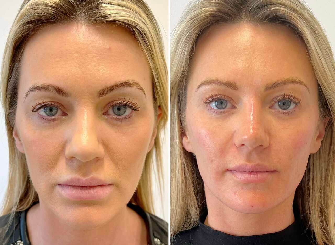 fillers4