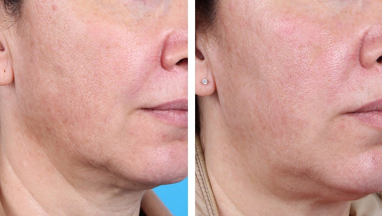 PRP Treatment in Paarl